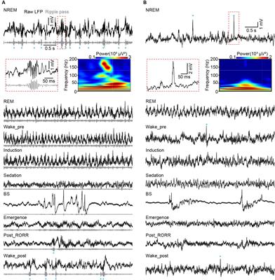 Electrophysiological activity pattern of mouse hippocampal CA1 and dentate gyrus under isoflurane anesthesia